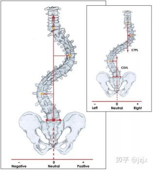 骶骨正中线CSVL与C7VL 颈7铅垂线距离