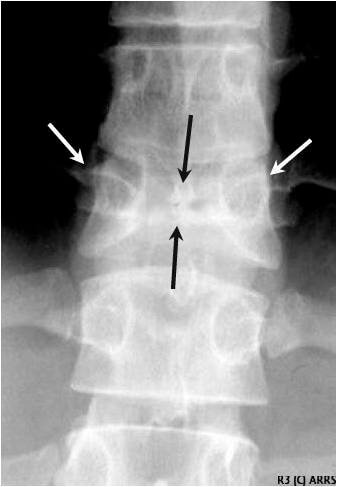 椎体蝴蝶椎Butterfly vertebra